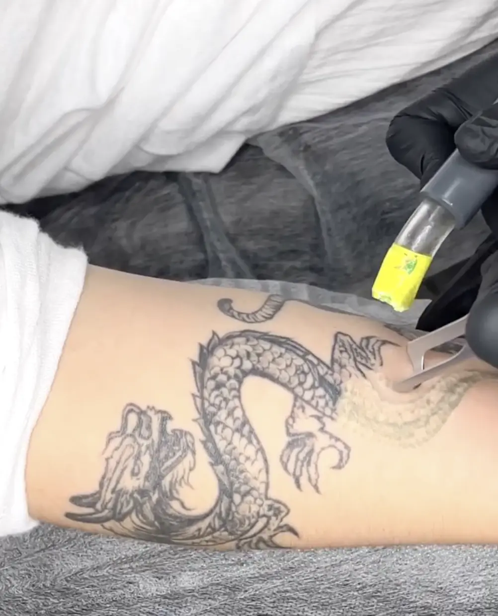 Saline tattoo removal Melbourne