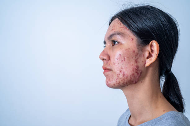 Best face wash for sebaceous hyperplasia: Effective skincare solution for managing skin condition.